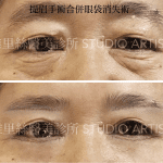 提眉+去眼袋手術