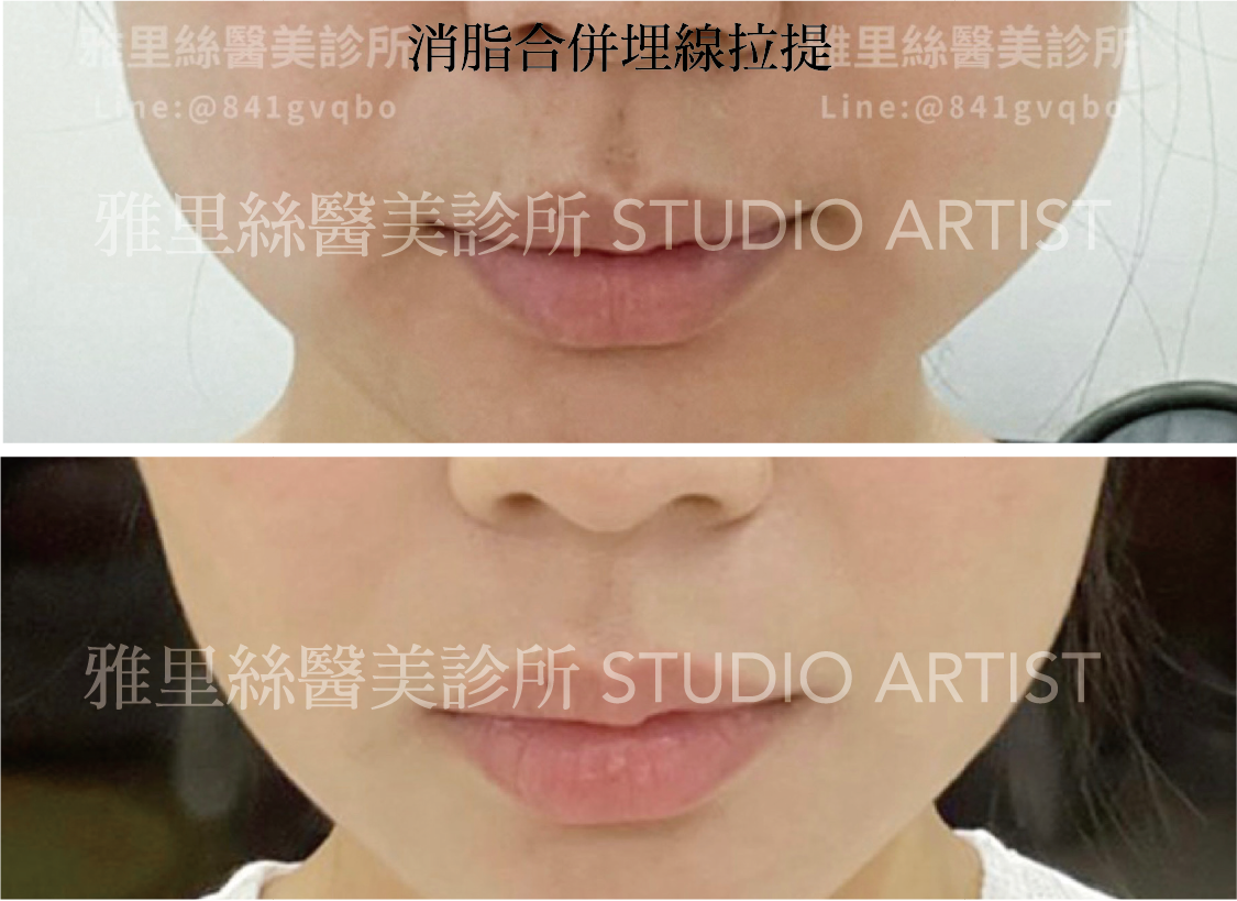 消脂合併埋線-01-01