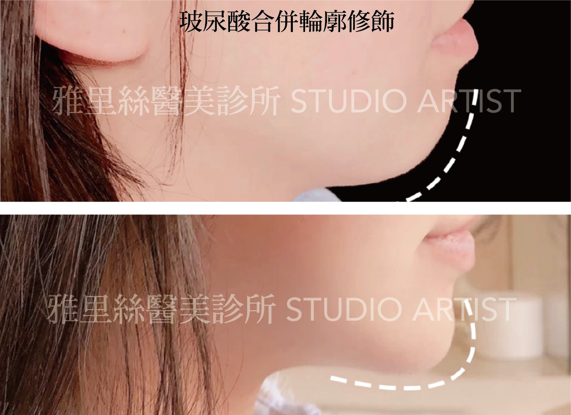 玻尿酸合併輪廓修飾