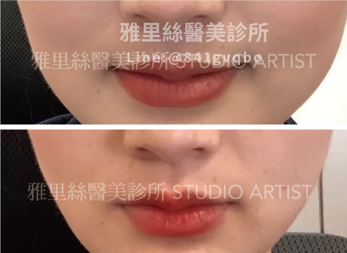 肉毒瘦臉針-01