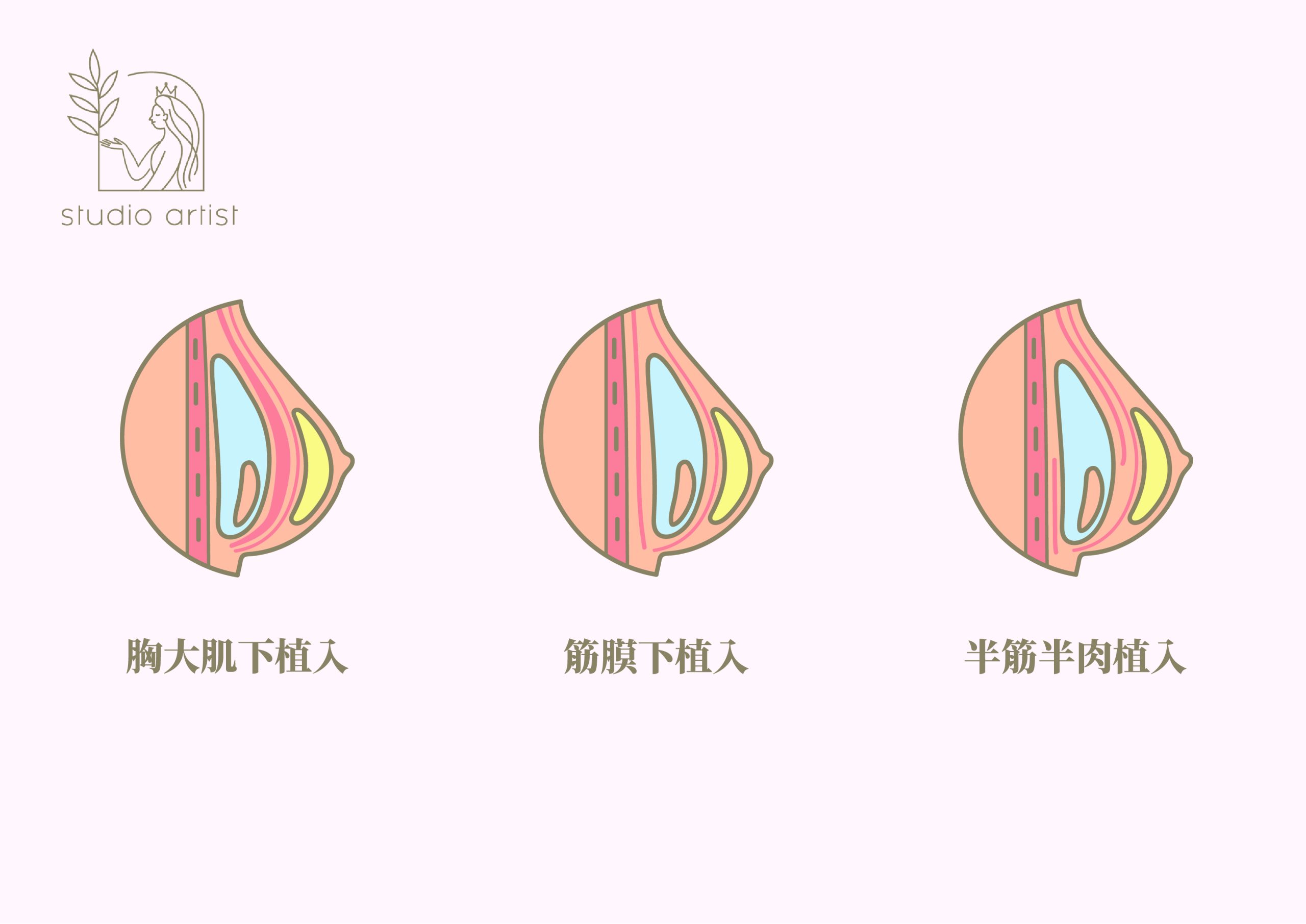 隆乳假體植入位置